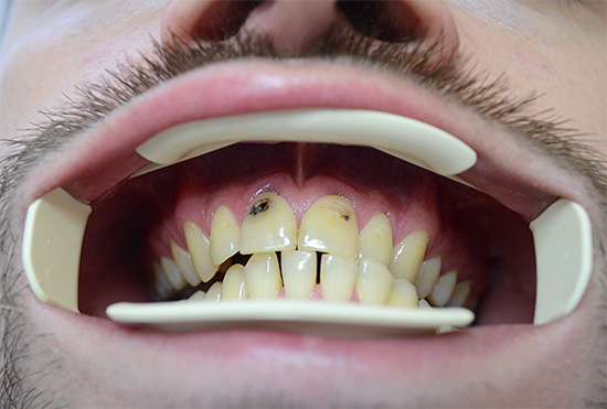 Uma grave cárie dos dentes da frente pode até causar complexos psicológicos.