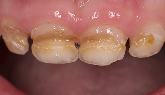 Um exemplo de cárie circular de dentes decíduos anteriores