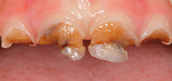 Com a cárie circular, a coroa do dente pode um dia simplesmente se romper.