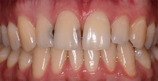 Cárie nas superfícies de contato dos dentes da frente