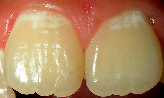 Áreas brancas no esmalte são zonas de maior desmineralização