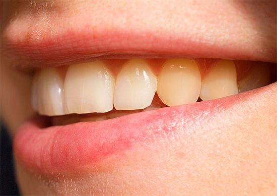 A complexidade da restauração dos dentes da frente é amplamente dependente de sua condição atual.