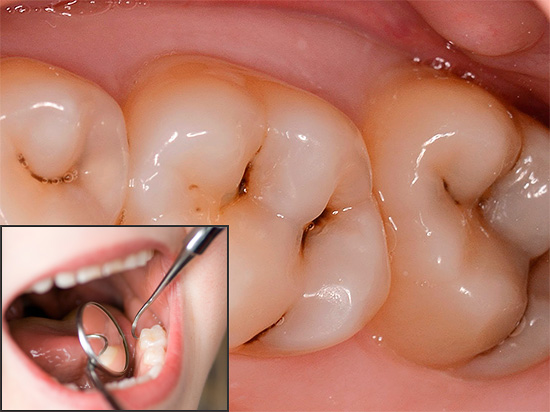 Na odontologia moderna, existem muitos métodos e abordagens interessantes no tratamento da cárie, sobre os quais falaremos mais detalhadamente ...