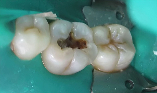 Ao tratar cáries profundas, é importante proteger a câmara pulpar dos efeitos tóxicos das substâncias do material de preenchimento - isso é conseguido usando almofadas isolantes.