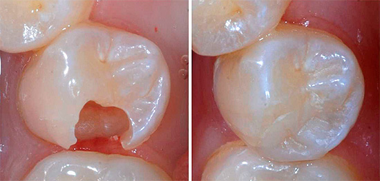 À esquerda na foto mostra um dente com uma cavidade formada e à direita - uma vista após a instalação do selo.