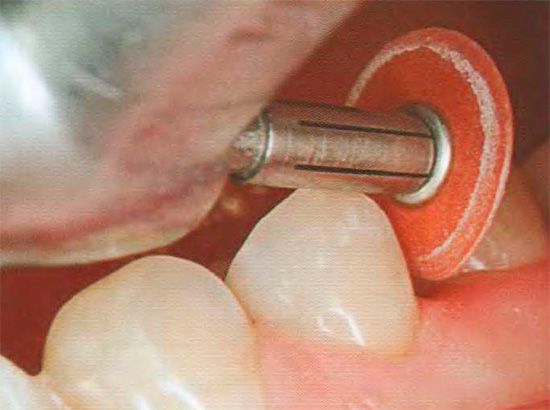 Ranger um dente após a restauração.