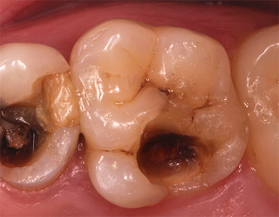 Os materiais de preenchimento usados ​​anteriormente pressupunham a excisão de uma quantidade significativa de tecido dentário duro para retenção confiável do preenchimento.