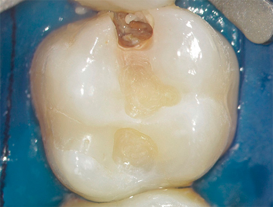 A aparência de materiais de preenchimento modernos reduziu significativamente o volume de tecido dentário excisado no tratamento de cárie.