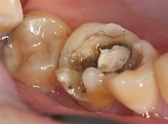 Na maioria dos casos, o tratamento de cárie profunda consome muito mais tempo do que nos estágios iniciais da cárie dentária.