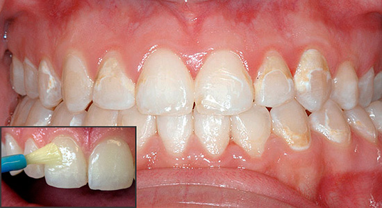 A terapia remineralizante permite saturar o esmalte dentário com componentes minerais e, assim, restaurar suas propriedades originais.