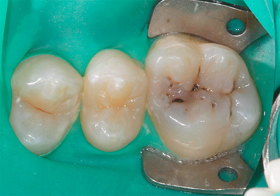 Fotografia de um dente com cárie de fissura antes do tratamento