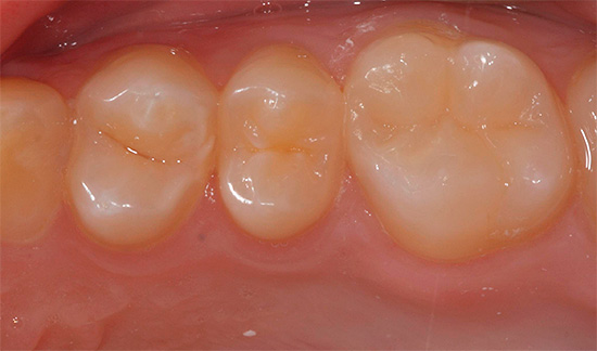 E o mesmo dente parece após a instalação do selo com o método sanduíche.