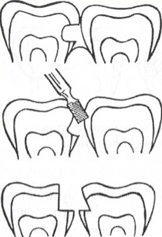 E aqui o médico erroneamente danificou um dente saudável vizinho