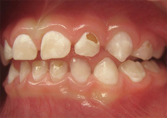 Se o tratamento não for iniciado a tempo, o processo de destruição afeta gradualmente os tecidos mais profundos do dente ...