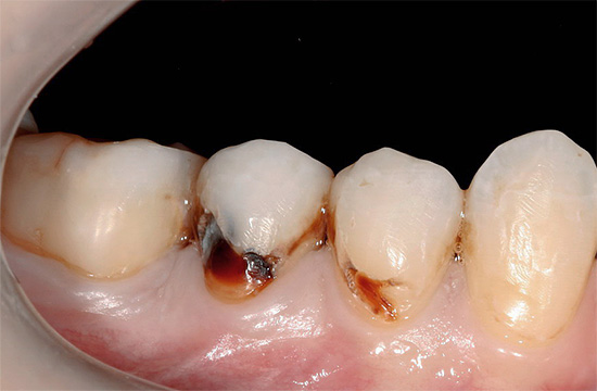 Cárie cervical profunda