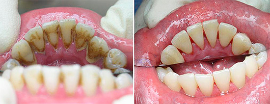 Antes do procedimento de tratamento, a placa e os depósitos minerais são removidos do dente doente (e às vezes de todos).
