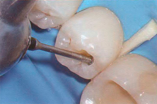 Um passo importante no procedimento é a preparação do dente, durante o qual os tecidos infectados e pigmentados são removidos.