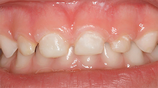 Cárie inicial dos dentes de leite do bebê - áreas brancas de desmineralização do esmalte são visíveis