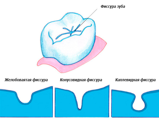 A imagem mostra as várias formas de fissuras dentárias