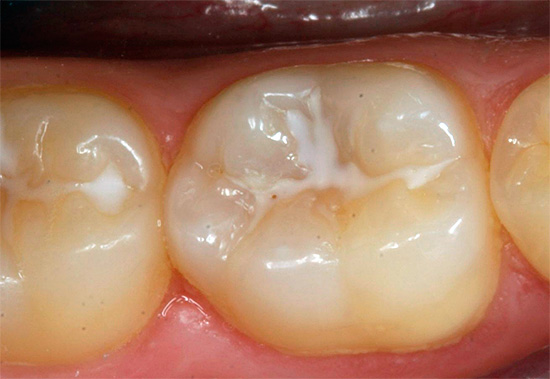 Dentes de mastigação de fissuras seladas