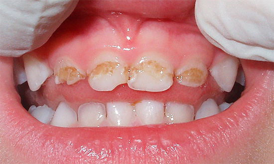 Na maioria dos casos, a deterioração severa dos dentes de leite do bebê é em grande parte culpa dos pais, que não prestaram a devida atenção às medidas preventivas.