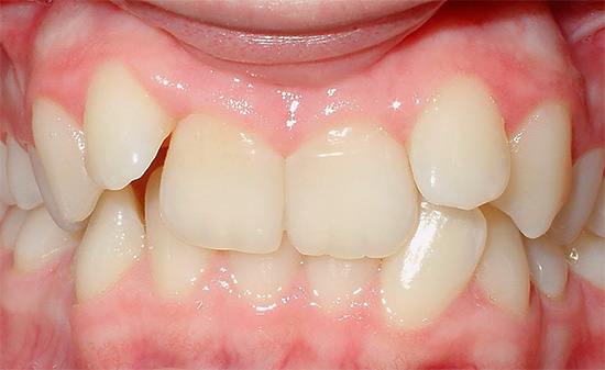 Se a criança perde os dentes de leite muito cedo, pode formar a mordida errada.