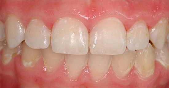 A foto mostra um exemplo da desmineralização iniciada do esmalte (áreas brancas na região cervical)