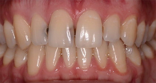 Um exemplo de cárie interdental nos dentes da frente