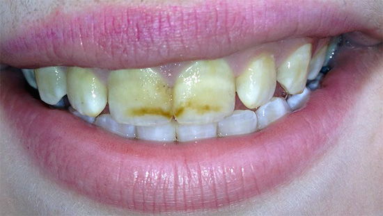 Uma redução acentuada no conteúdo de elementos químicos importantes na saliva de uma mulher grávida pode levar à desmineralização acelerada do esmalte dentário.