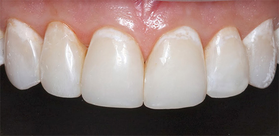 Cárie inicial no estágio de uma mancha branca - na região cervical dos dentes, são visíveis focos de desmineralização do esmalte.
