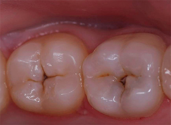 Muitas receitas populares para a cárie dentária, na verdade, só contribuem para a destruição acelerada dos dentes.
