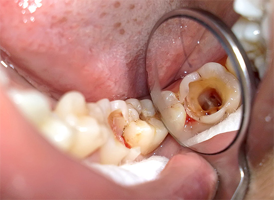 I canali radicolari del dente sono visibili nella foto - dopo la pulizia saranno sigillati.