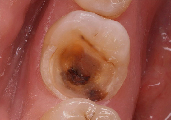 Spesso si rivolgono per aiuto in casi avanzati quando il pus con un odore sgradevole proviene già dal canale dentale.