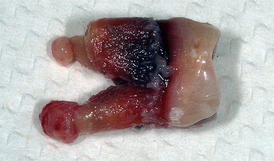 Dente rimosso con cisti sulle radici