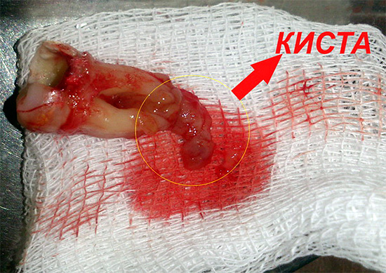 La parodontite cronica spesso porta alla necessità di estrazione dei denti.