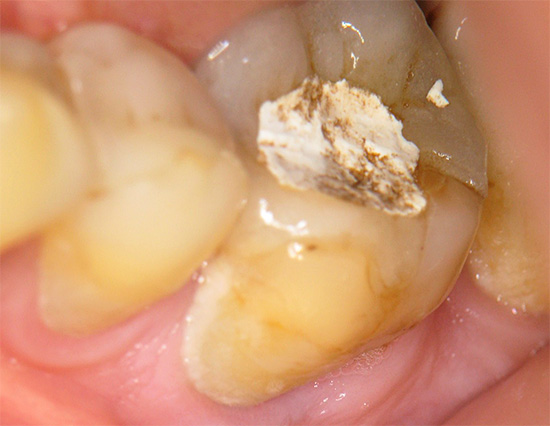 Riempimento temporaneo dei denti