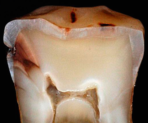 Su una sezione di un dente reale, si può vedere chiaramente come, nel tempo, la carie profonda si diffonde nella camera pulpare.