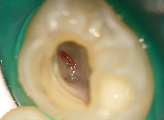 La fotografia mostra che durante la preparazione del dente è stata aperta la camera della polpa.