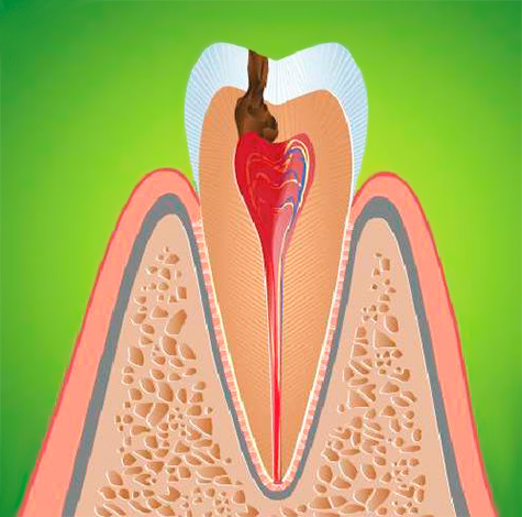 L'infiammazione dei tessuti molli nella camera pulpare del dente è accompagnata da un intero complesso di sintomi caratteristici, che considereremo ulteriormente.