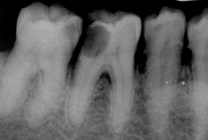 Questa radiografia mostra chiaramente che la cavità cariata raggiunge la camera pulpare.
