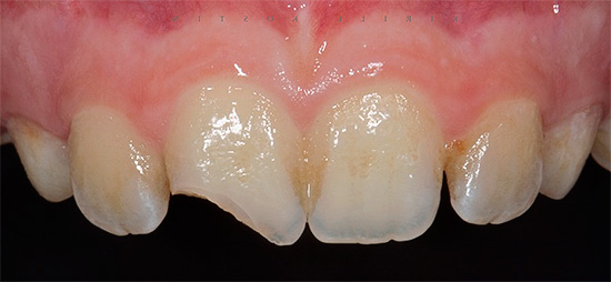 Con un grave trauma dentale, spesso si sviluppa la pulite traumatica