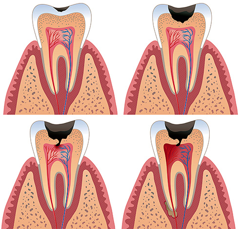 Se il trattamento non viene avviato in tempo, il nervo del dente morto si decomporrà direttamente nella camera pulpare e l'infezione influenzerà i tessuti circostanti il ​​dente.