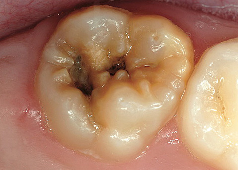 Con carie profonde, lo spessore dello strato di dentina che protegge il fascio neurovascolare all'interno del dente è molto piccolo.