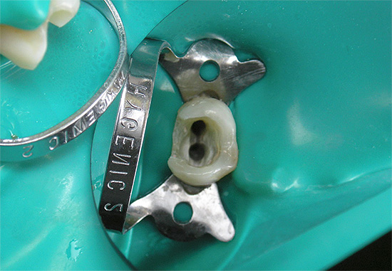 Nella foto, la bocca dei canali radicolari del dente è chiaramente visibile