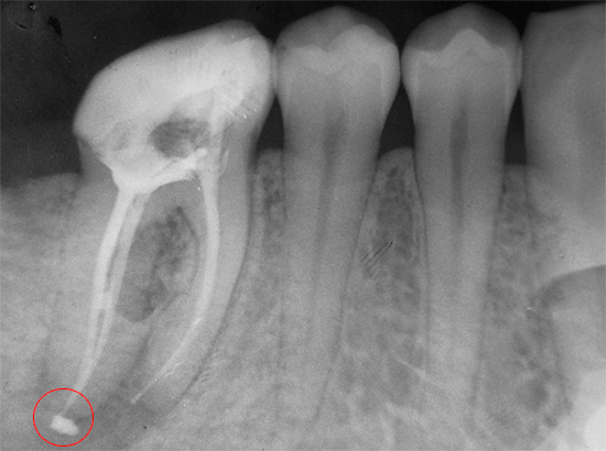 Un esempio di canale sigillato con la rimozione di materiale di riempimento oltre il bordo della radice del dente nella gomma.