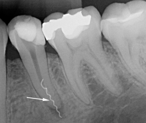 La fotografia mostra un pezzo di uno strumento dentale rotto in un canale.