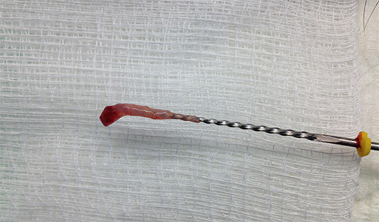 Se non rimuovi tutta la polpa infetta dai canali, può anche diventare una fonte di infiammazione alla radice del dente.