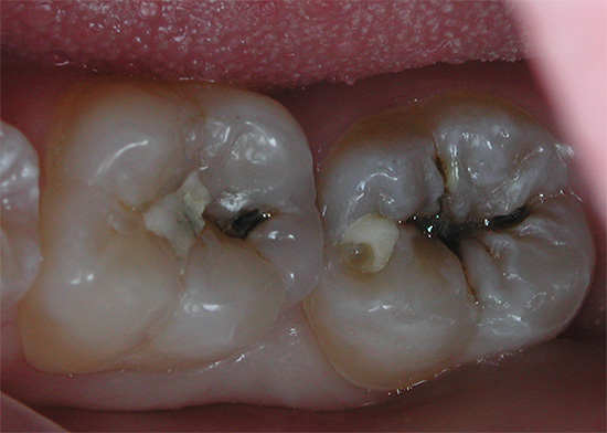 Masticare i denti con carie profonde: sono visibili vecchie otturazioni che verranno rimosse durante il trattamento.