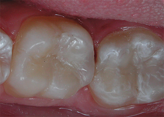 E così gli stessi denti si occupano del trattamento.