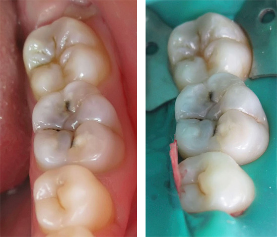 L'impatto sul dente con un trapano e, inoltre, la rimozione di un nervo da esso è una sorta di intervento chirurgico per rimuovere i tessuti infetti.